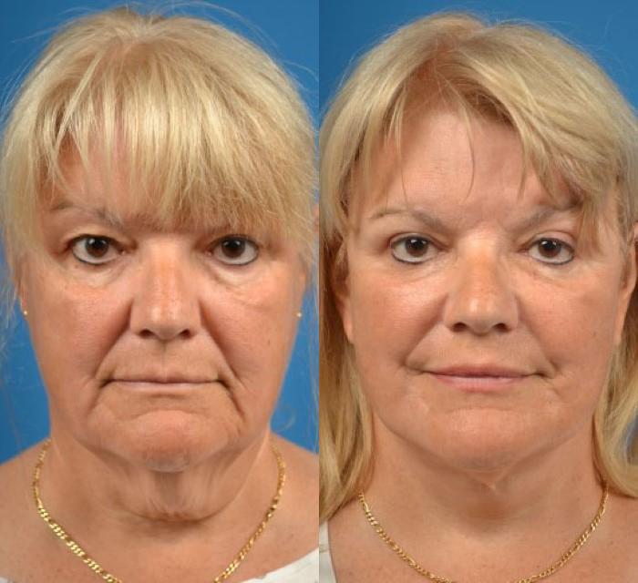 Facelift Before & After Gallery - Patient 122405963 - Image 1