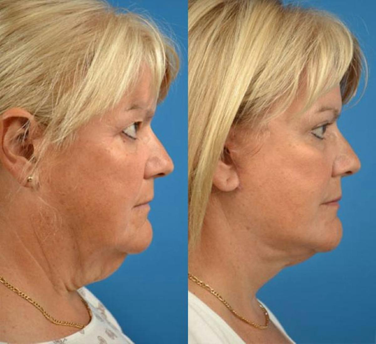 Facelift Before & After Gallery - Patient 122405963 - Image 2