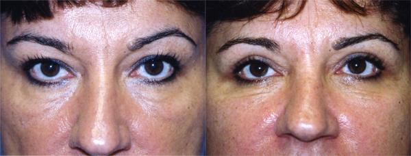 Eyelid Surgery Before & After Gallery - Patient 304594 - Image 1