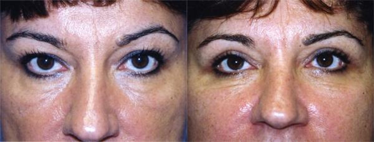 Eyelid Surgery Before & After Gallery - Patient 122405965 - Image 1
