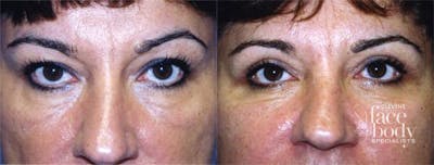 Eyelid Surgery Before & After Gallery - Patient 304594 - Image 1