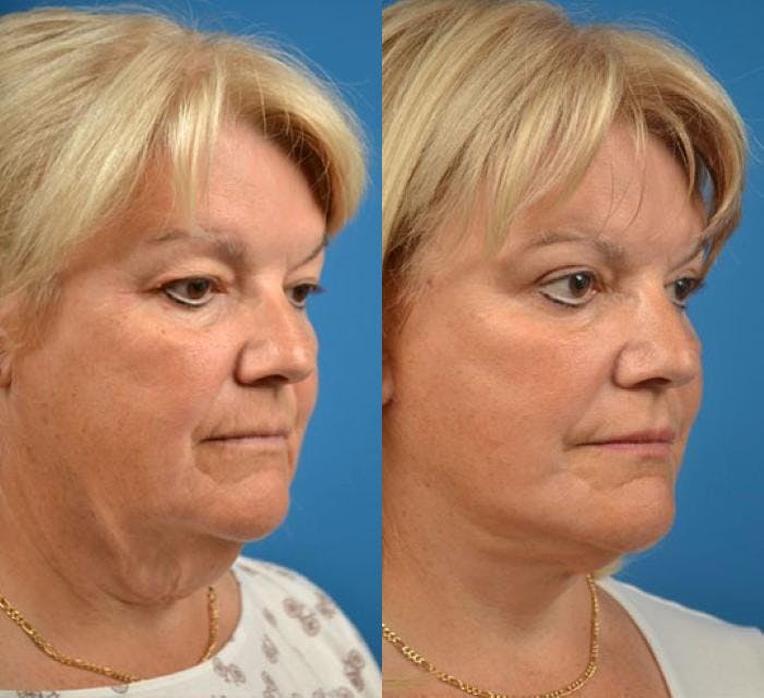 Facelift Before & After Gallery - Patient 122405963 - Image 3