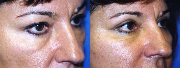 Eyelid Surgery Gallery - Patient 122405965 - Image 2