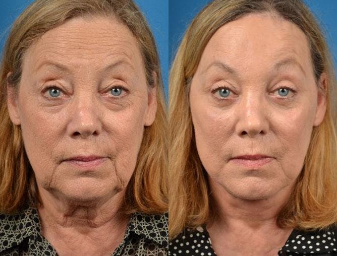 Facelift Before & After Gallery - Patient 122405968 - Image 1