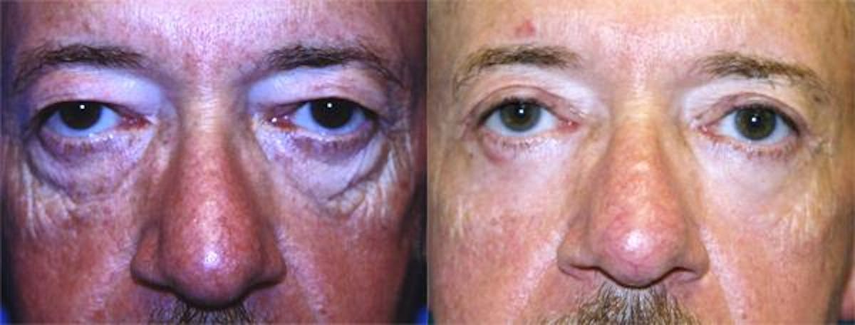 Eyelid Surgery Before & After Gallery - Patient 122405966 - Image 1