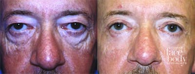 Eyelid Surgery Before & After Gallery - Patient 213210 - Image 1