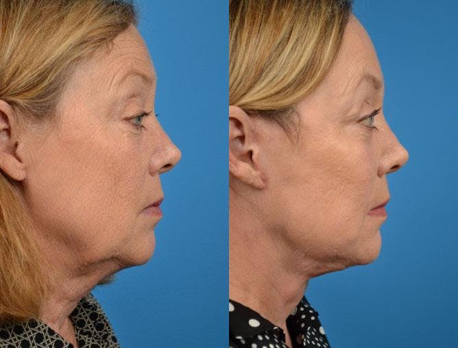 Facelift Before & After Gallery - Patient 122405968 - Image 2