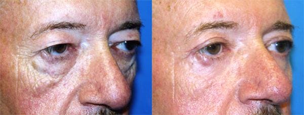 Eyelid Surgery Before & After Gallery - Patient 122405966 - Image 2