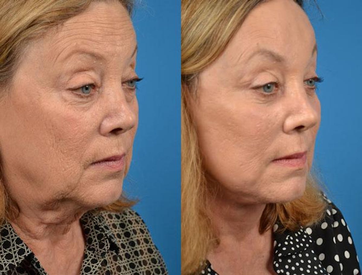 Facelift Before & After Gallery - Patient 122405968 - Image 3