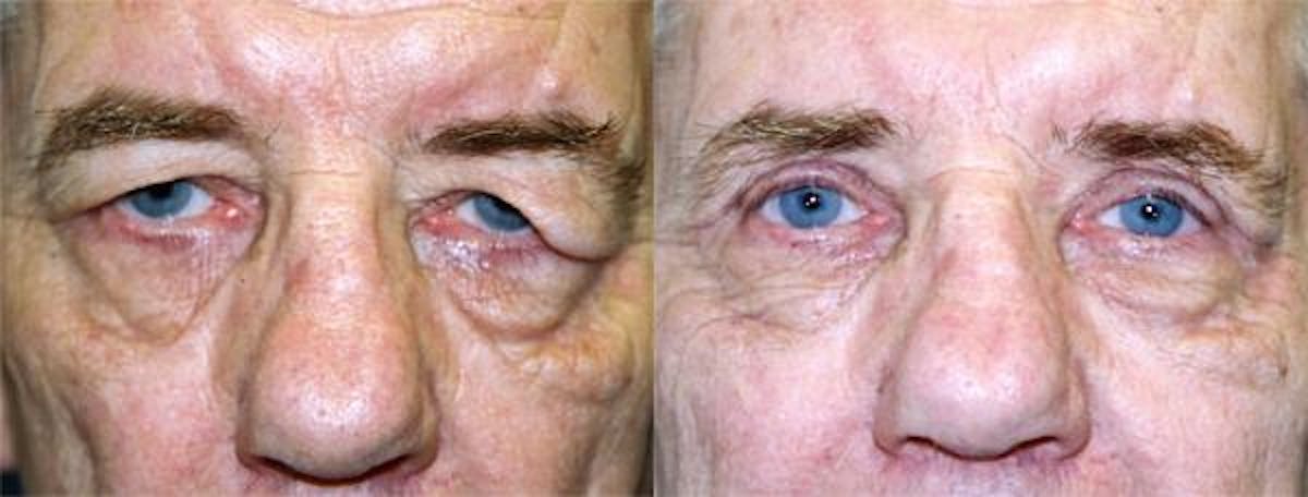 Eyelid Surgery Before & After Gallery - Patient 122405969 - Image 1