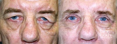 Eyelid Surgery Before & After Gallery - Patient 672669 - Image 1