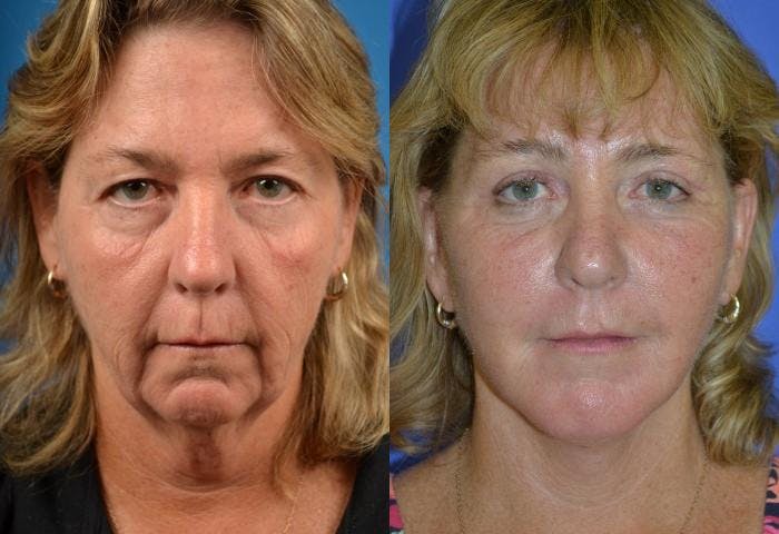 Facelift Before & After Gallery - Patient 122405971 - Image 1