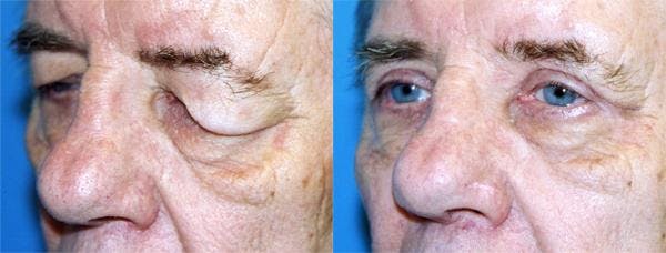 Eyelid Surgery Before & After Gallery - Patient 122405969 - Image 2