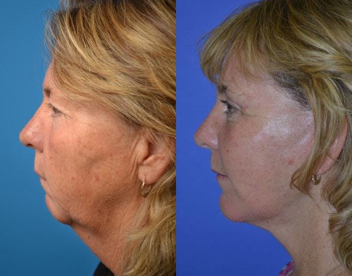 Facelift Before & After Gallery - Patient 122405971 - Image 2