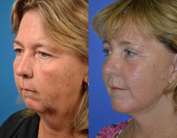 Facelift Before & After Gallery - Patient 122405971 - Image 3