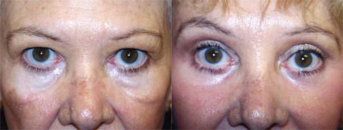 Eyelid Surgery Before & After Gallery - Patient 122405973 - Image 1