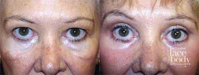 Eyelid Surgery Before & After Gallery - Patient 255052 - Image 1