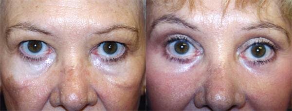 Eyelid Surgery Before & After Gallery - Patient 122405973 - Image 1