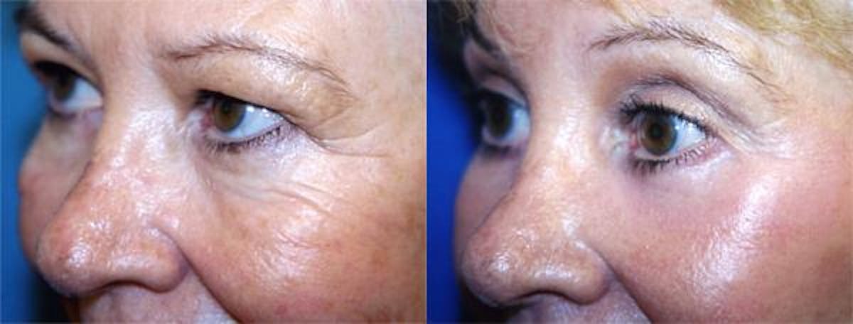 Eyelid Surgery Before & After Gallery - Patient 122405973 - Image 2