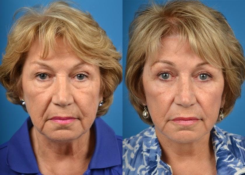 Facelift Before & After Gallery - Patient 122405979 - Image 1