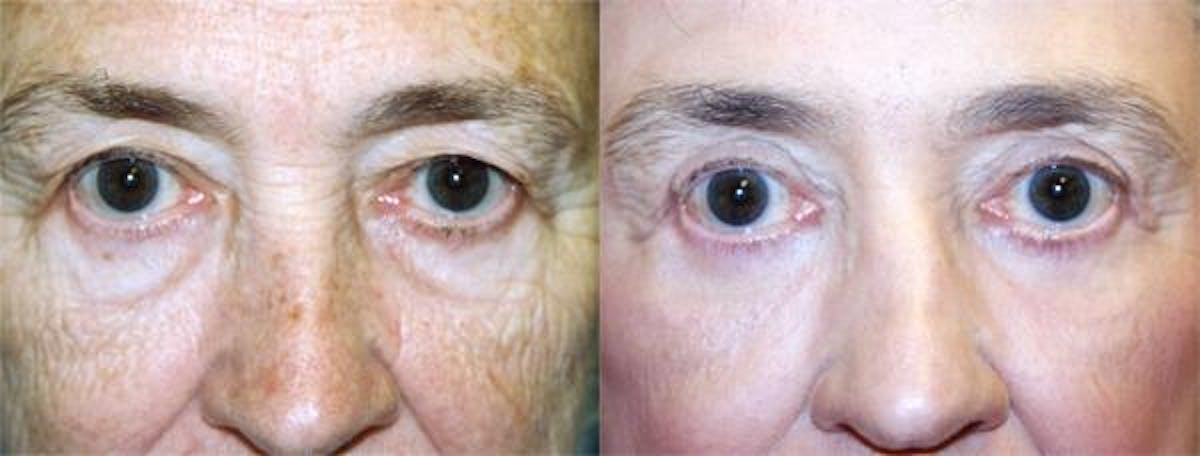 Eyelid Surgery Before & After Gallery - Patient 122405975 - Image 1