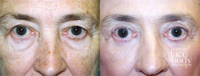 Eyelid Surgery Before & After Gallery - Patient 214763 - Image 1