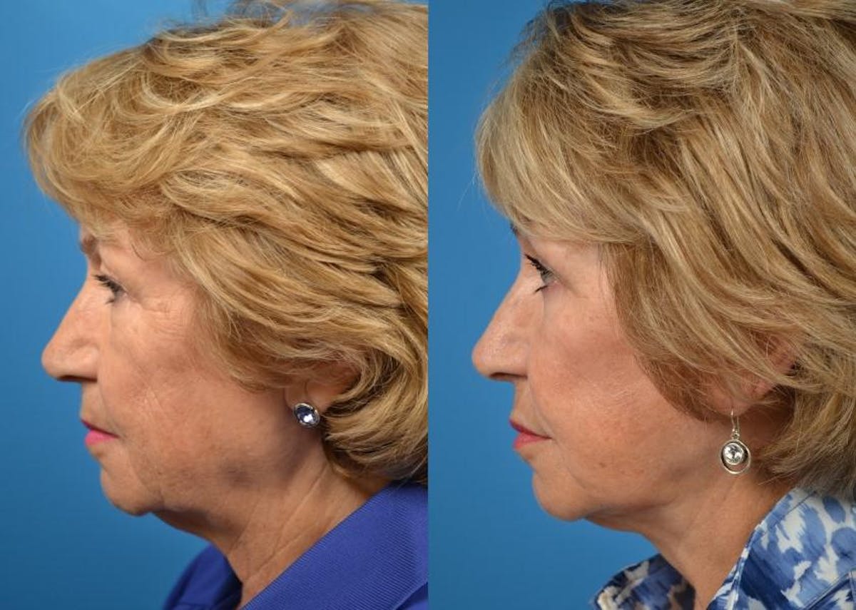 Facelift Before & After Gallery - Patient 122405979 - Image 2