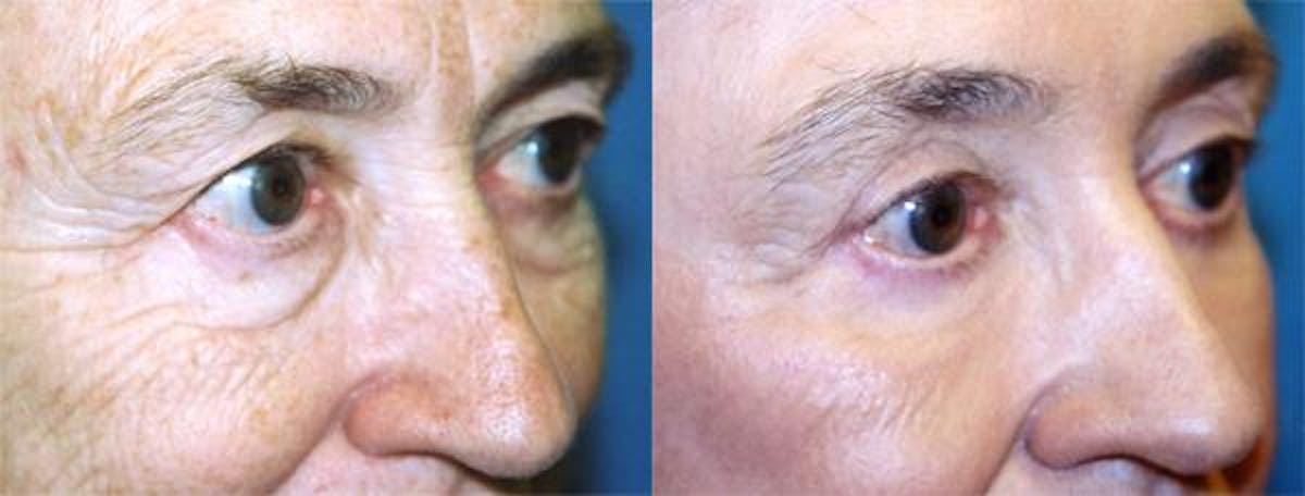 Eyelid Surgery Before & After Gallery - Patient 122405975 - Image 2