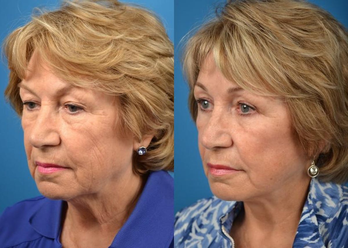 Facelift Before & After Gallery - Patient 122405979 - Image 3