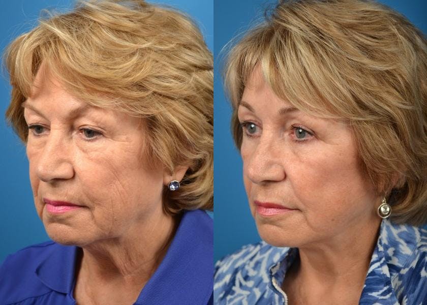 Facelift Before & After Gallery - Patient 122405979 - Image 3