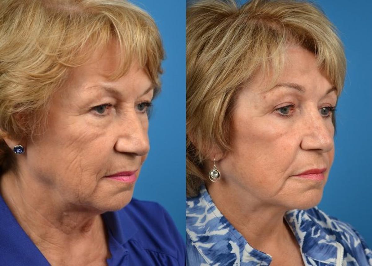 Facelift Before & After Gallery - Patient 122405979 - Image 4