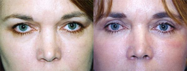 Eyelid Surgery Before & After Gallery - Patient 218466 - Image 1