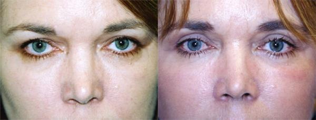 Eyelid Surgery Before & After Gallery - Patient 122405978 - Image 1