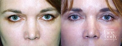 Eyelid Surgery Before & After Gallery - Patient 218466 - Image 1