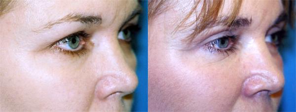 Eyelid Surgery Before & After Gallery - Patient 218466 - Image 2