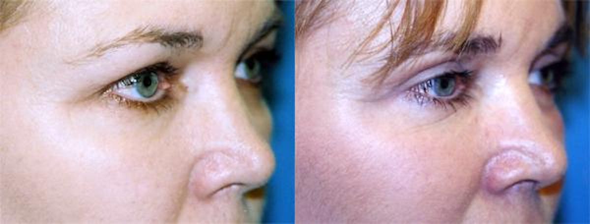 Eyelid Surgery Before & After Gallery - Patient 122405978 - Image 2