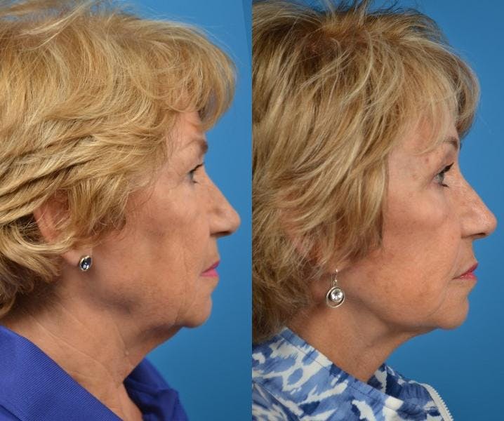 Facelift Before & After Gallery - Patient 122405979 - Image 5