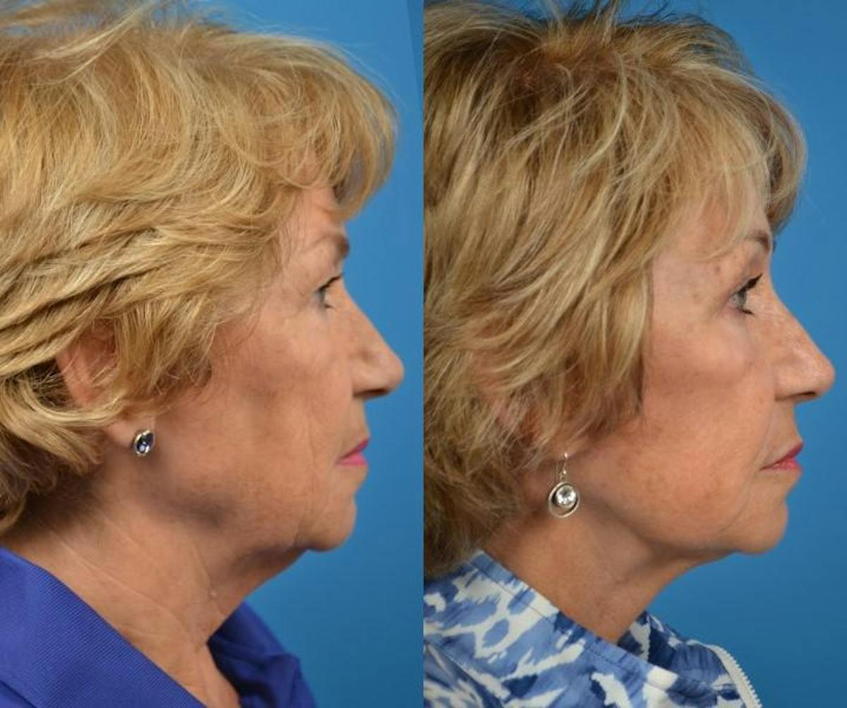 Facelift Before & After Gallery - Patient 122405979 - Image 5