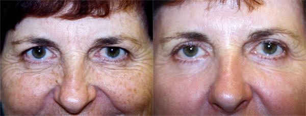 Eyelid Surgery Before & After Gallery - Patient 409475 - Image 1