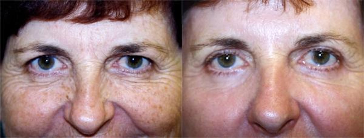 Eyelid Surgery Before & After Gallery - Patient 122405981 - Image 1