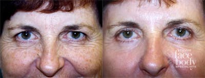 Eyelid Surgery Before & After Gallery - Patient 409475 - Image 1