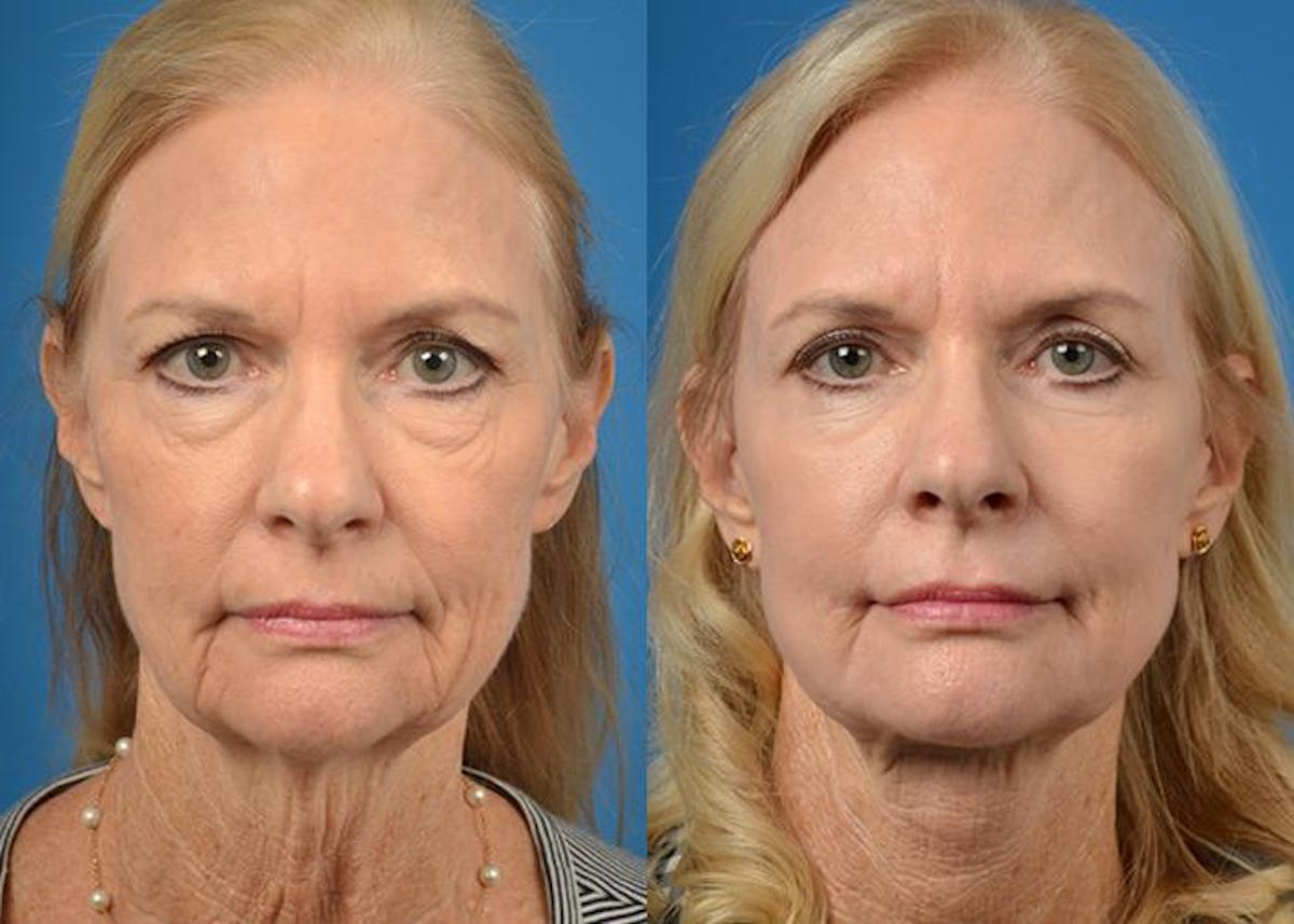 Facelift Before & After Gallery - Patient 122405988 - Image 1