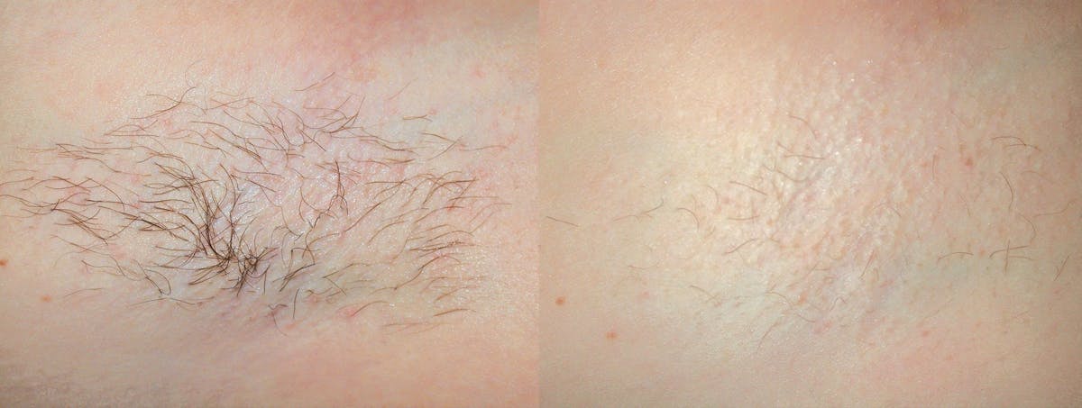 Laser Hair Removal Before & After Gallery - Patient 122405983 - Image 1