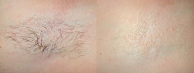 Laser Hair Removal Before & After Gallery - Patient 122405983 - Image 1