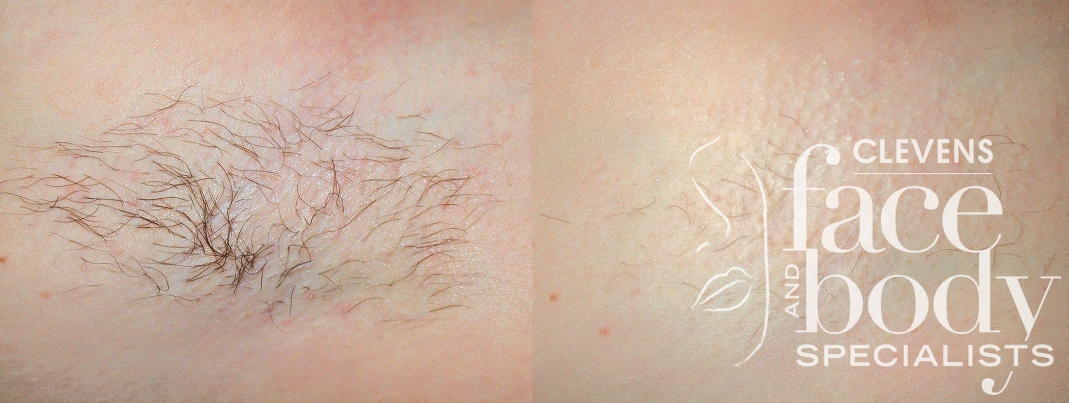 Laser Hair Removal