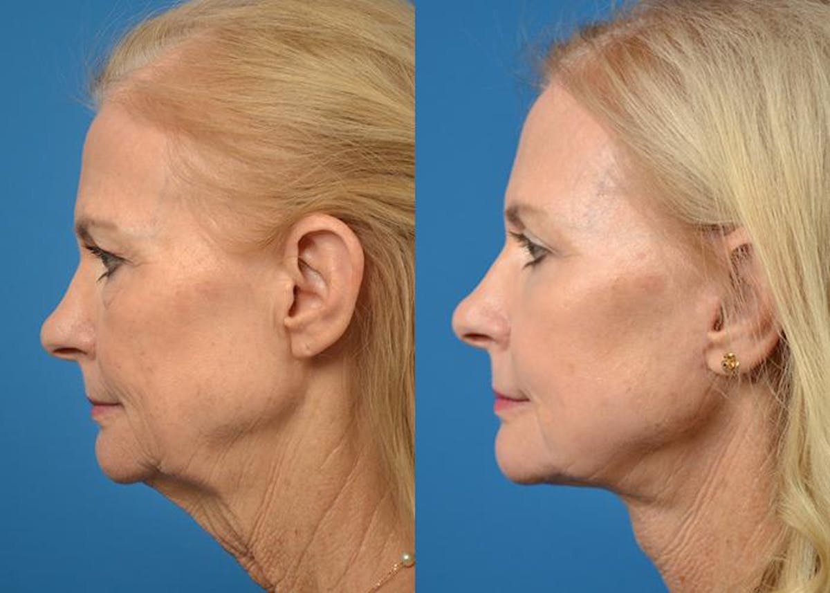Facelift Before & After Gallery - Patient 122405988 - Image 2