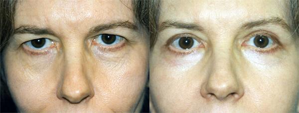 Eyelid Surgery Before & After Gallery - Patient 182453 - Image 1