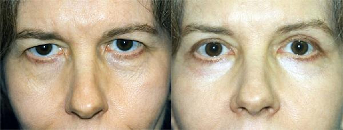 Eyelid Surgery Before & After Gallery - Patient 122405984 - Image 1