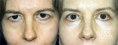 Eyelid Surgery Before & After Gallery - Patient 182453 - Image 1