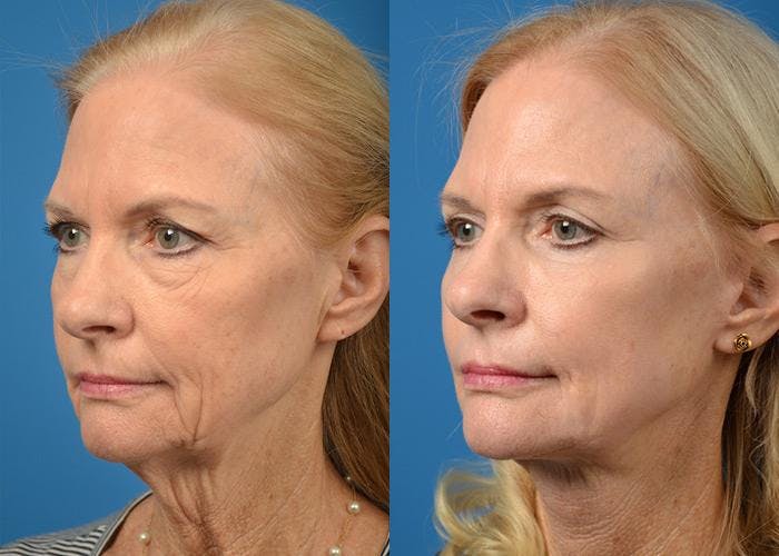 Facelift Before & After Gallery - Patient 122405988 - Image 3